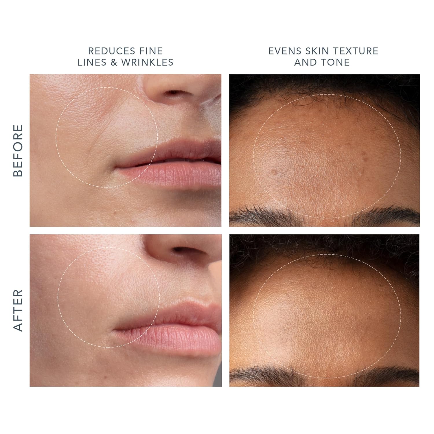 FOREO KIWI derma Microdermabrasion Machine Whitehead & Black Head Remover for Face - Skin Care Tools - Blackhead Extractor - No Pore Strips Suction - Vacuum Blackhead Remover image 4