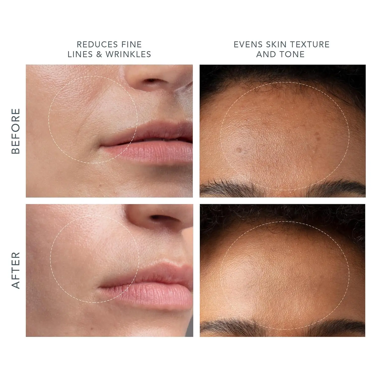 FOREO KIWI derma Microdermabrasion Machine Whitehead & Black Head Remover for Face - Skin Care Tools - Blackhead Extractor - No Pore Strips Suction - Vacuum Blackhead Remover image 4